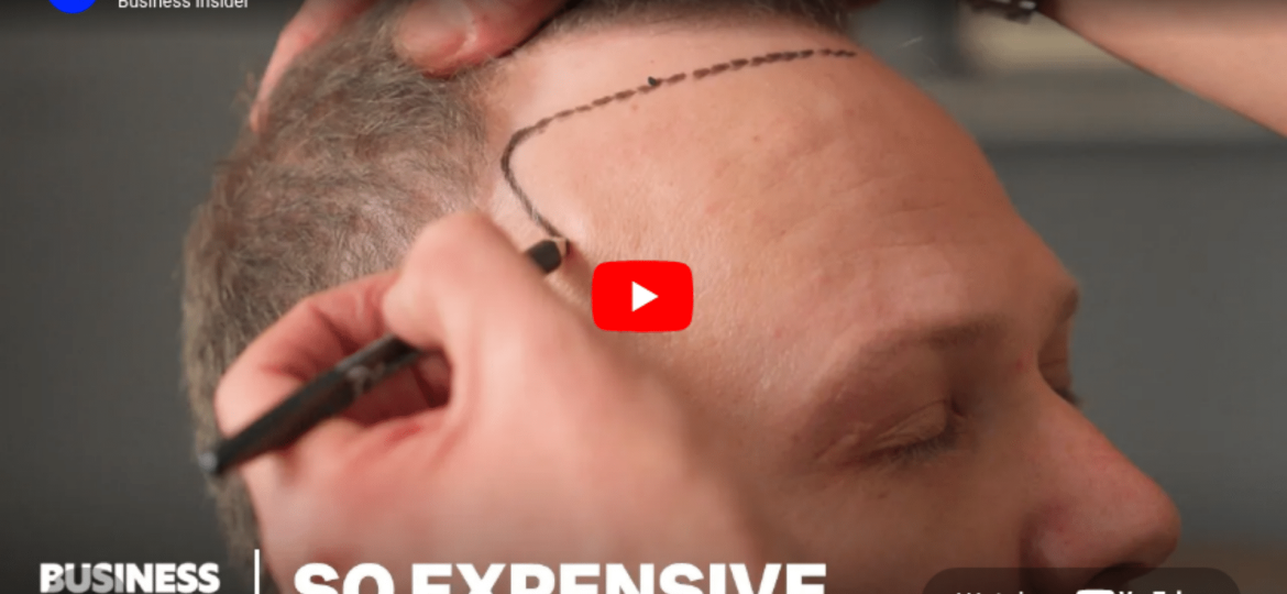 Inside Turkey's $2B hair transplant tourism boom