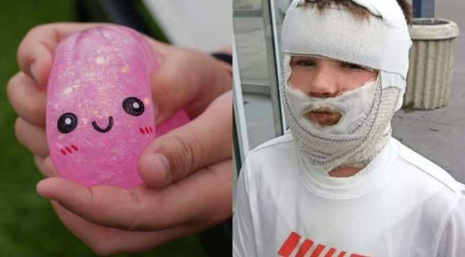 Trendy “Squishy” Toy Bursts and Burns a Young Boy in France