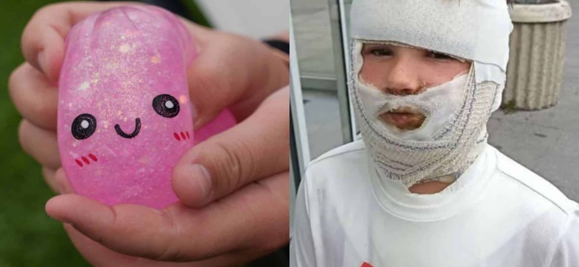 Trendy “Squishy” Toy Bursts and Burns a Young Boy in France